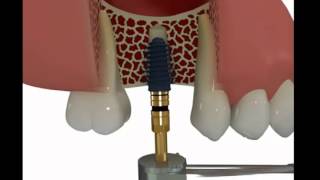 AnyRide Narrated Overview of Implant Placement