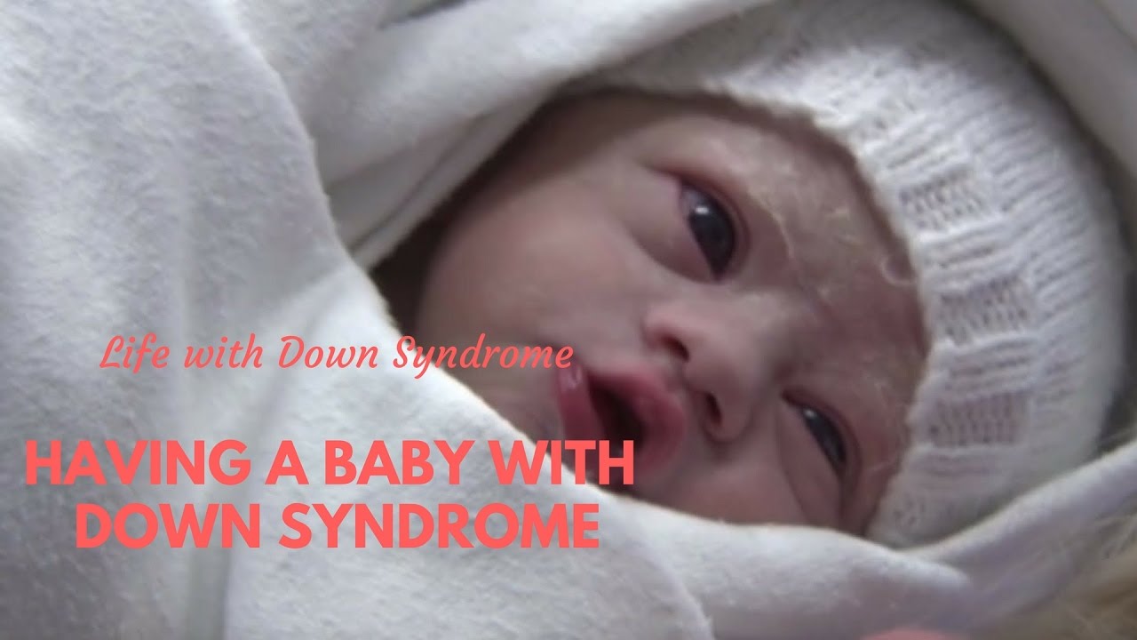 Down Syndrome Baby