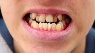 Invisalign at Metro Dental of New Carrollton, MD