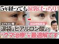 【涙袋の作り方】クマ治療から5年経っても"涙袋"がぱっちりな症例を大公開！涙袋にはヒアルロン酸ではなく"経結膜脱脂術"をオススメする理由を美容外科医が分かりやすく解説します！
