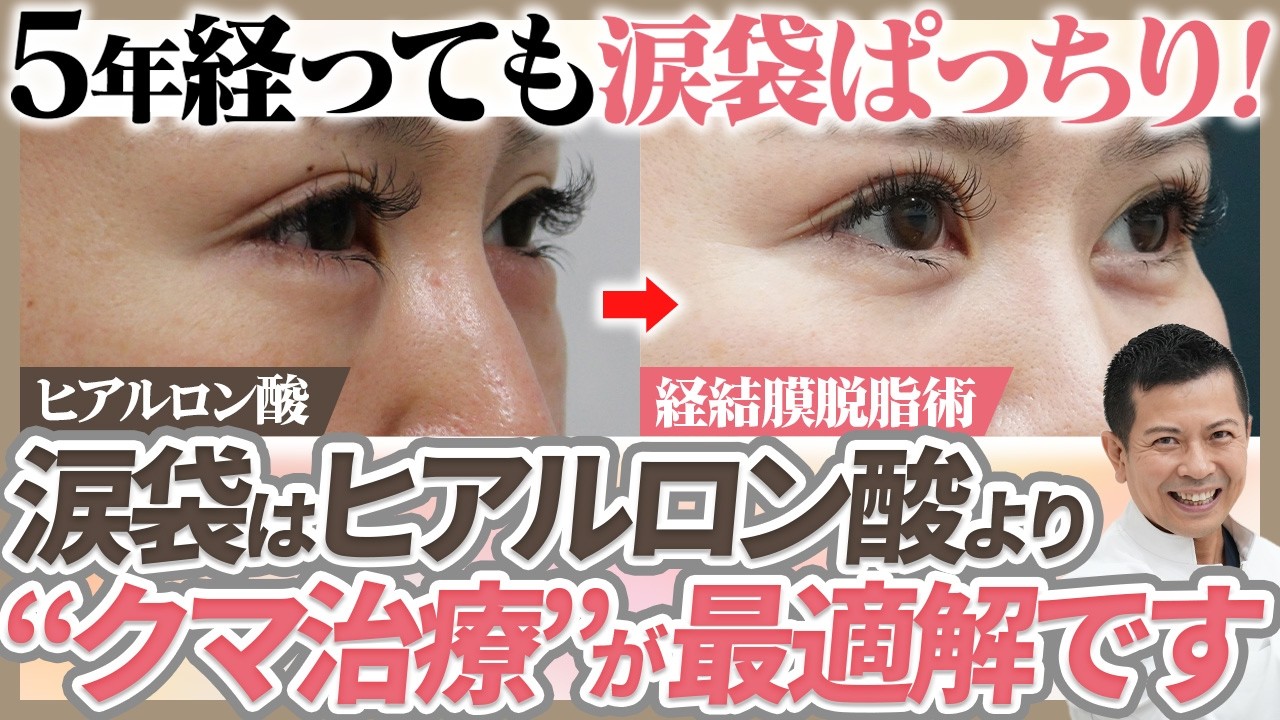 【涙袋の作り方】クマ治療から5年経っても"涙袋"がぱっちりな症例を大公開！涙袋にはヒアルロン酸ではなく"経結膜脱脂術"をオススメする理由を美容外科医が分かりやすく解説します！