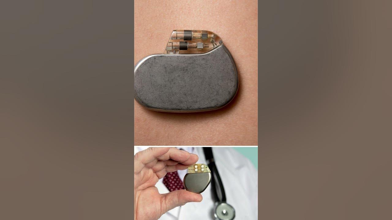 Pacemaker parts pulse generator, battery and lead Single vs Dual