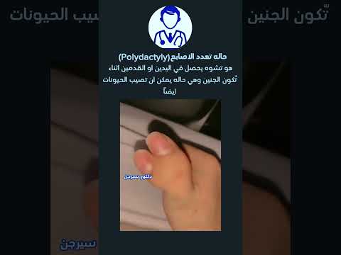 حاله تعدد الاصابع  دكتور سيرجن اكسبلور طب