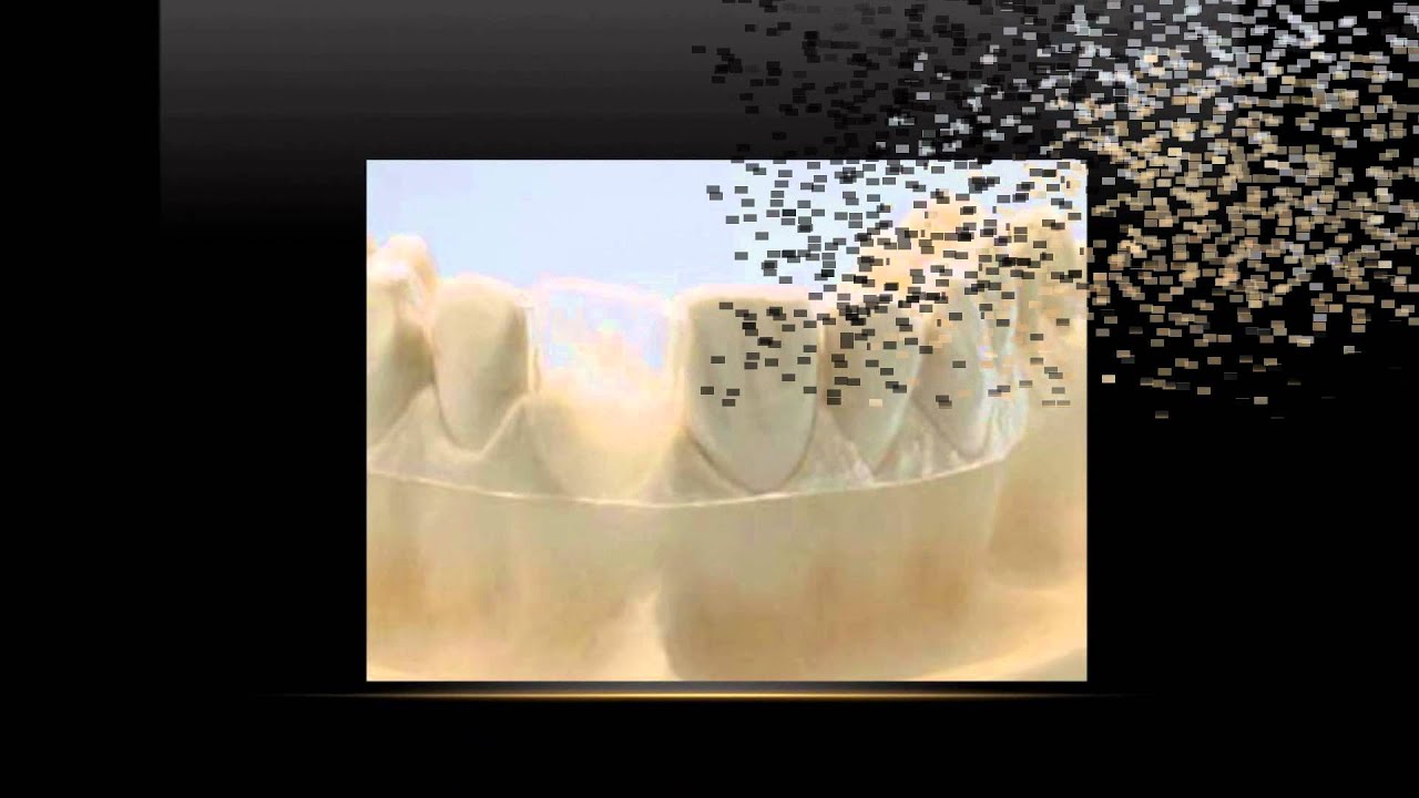 Férulas quirurgicas en implantología.wmv - YouTube