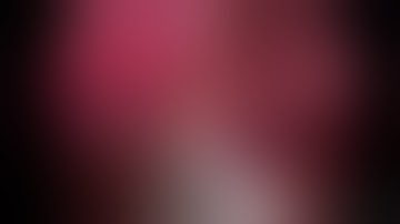 Anatomical laparoscopic liver resection of segment 2 for HCC in cirrhotic patient