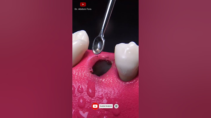 Fractured tooth extraction in 4K #Shorts