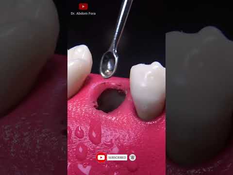 Video: Las 3 mejores formas de sacar un diente sin dolor - wikiHow