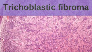 Trichoblastic Fibroma - Pathology mini tutorial