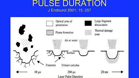 Update on Laser Lithotripsy