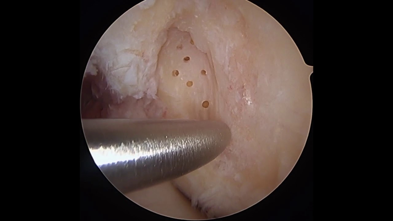 Arthroscopic Treatment of Medial Femoral Knee