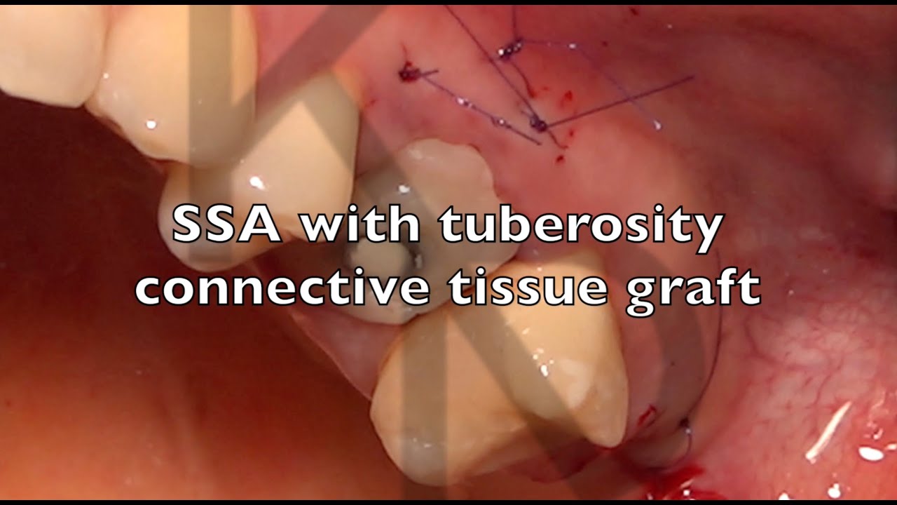 SSA with tuberosity connective tissue graft YouTube
