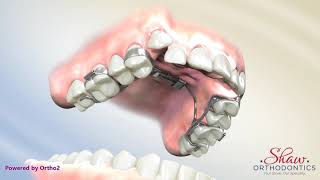 Shaw Orthodontics Crossbow Appliance