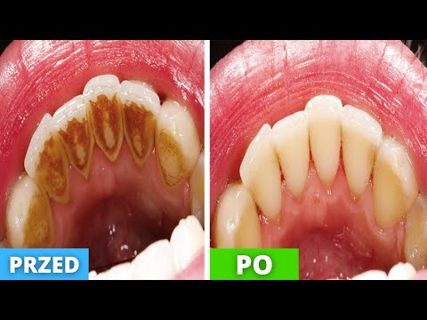 Wideo: 3 sposoby na opłacenie dentysty