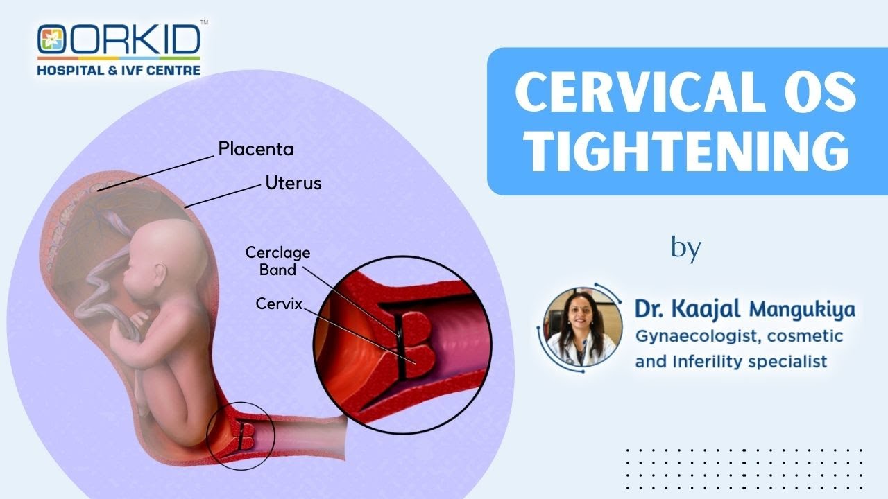 Cervical OS Tightening Cervical Mouth Stitch Cervix Treatment In 