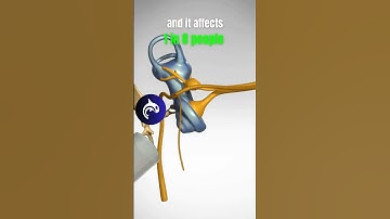 See what Hearing Loss from Nerve Damage looks like in a 4K 3D animation.