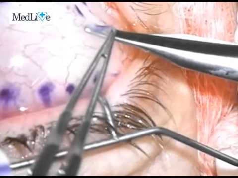 OPERATIE - Formatiune tumorala corneo-conjunctivala, tratament chirurgical complet