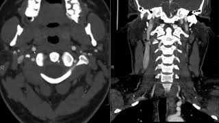 CTA Head and Neck