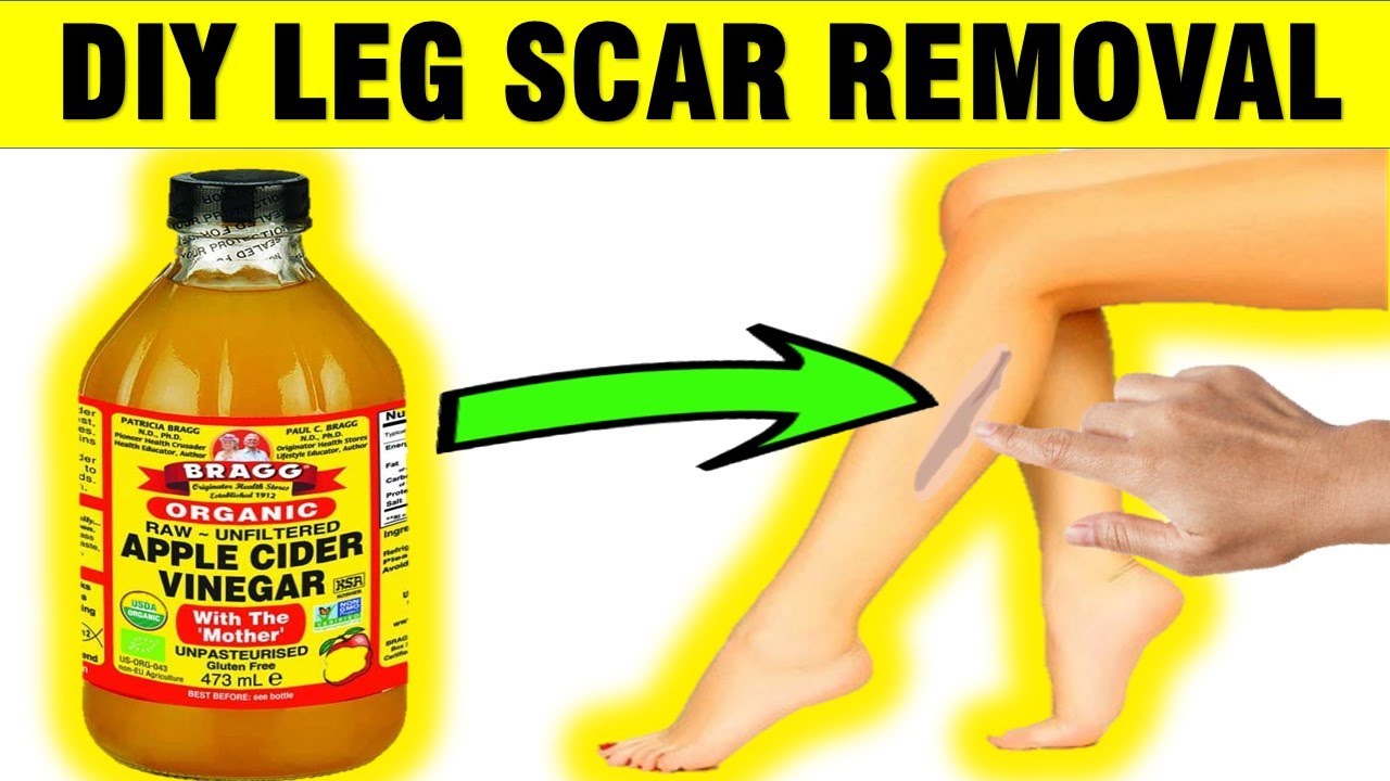How To Remove Scars and Dark Spots on Legs Fast Naturally 
