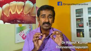 Gum Disease: Causes, Prevention,