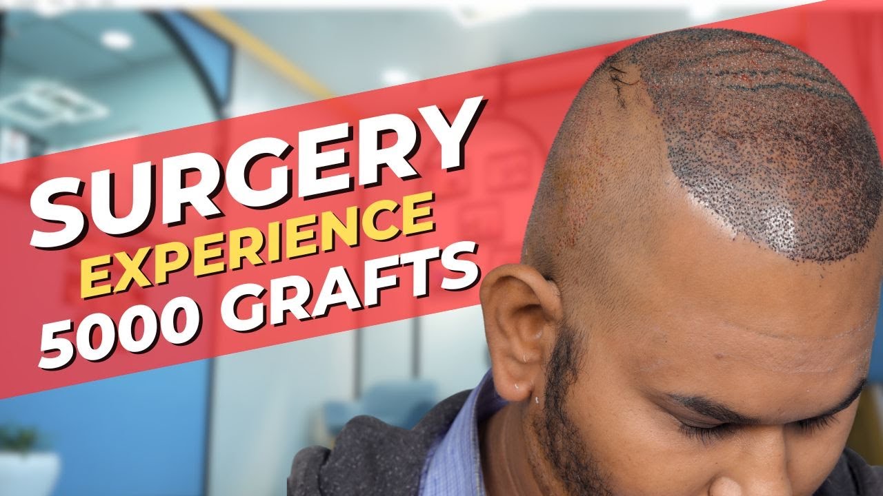 Hair Transplant in Raipur Best Results & Cost of Hair Transplant in