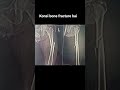 Konsi bone fracture hai guys 💫 🦴🧑🏼‍⚕️💫