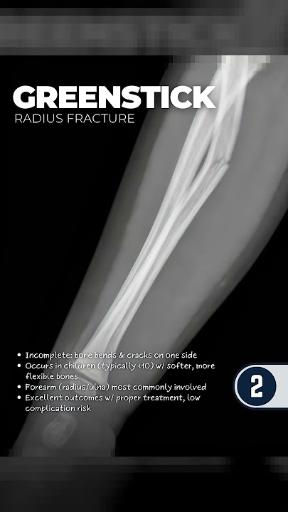 This Bone Fracture Type NEEDS Emergency Treatment⁉️