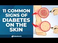 11 common signs of diabetes on the skin