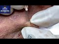 Cystic acne treatment  cyst and blackhead extraction  pimple popping  clogged pores 2