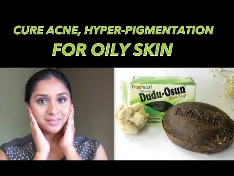 How to Cure Acne & Fade Blemishes | African Black Soap Review
