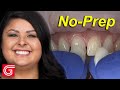 How to seat noprep veneers for anterior teeth 4 13