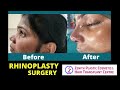 Rhinoplasty in guwahati asansol jalpaigudi durgapur jorhat imphal shillong agartala gangtok