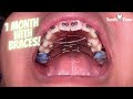 Braces checkups - Getting a Rapid Palatal Expander and Tongue crib - Tooth Time New Braunfels