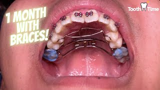 Braces checkups - Getting a Rapid Palatal Expander and Tongue crib - Tooth Time New Braunfels