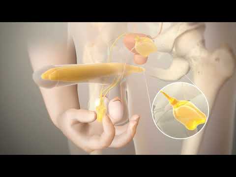 Penile Implants for Erectile Dysfunction - Dr. Sanjay Razdan