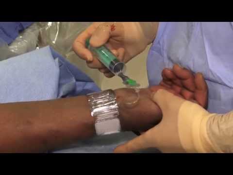 The Transradial Approach to Cardiac Catheterization