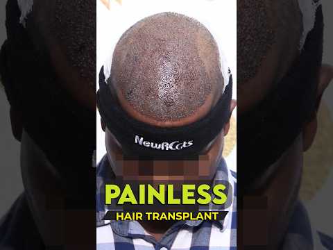 Painless Hair Transplant in Hyderabad #painlesshairtransplant #hairtransplant #shorts