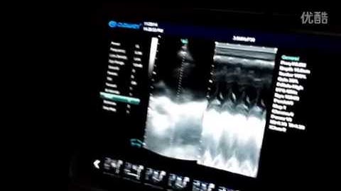 Demo video of DW C60plus with phased array probe