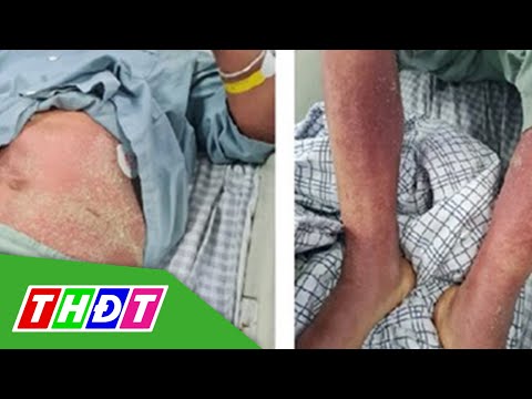 Video 2 bệnh nhân ở Phú Thọ bị viêm màng não, nhiễm khuẩn... - youtube