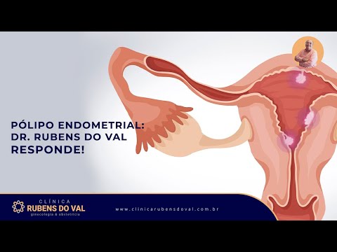 Pólipo endometrial: Dr. Rubens do Val responde! | Clínica Rubens do Val CRM 58764