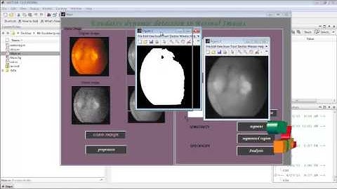 Final Year Projects | Exudates dynamic detection in retinal fundus images based on the noise