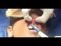 Franulum lip release / Cautery/ Laser - Dr Hitesh Patel