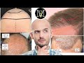 What to look for in a good hair transplant