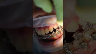 RETIRO DE BRACKETS (ASMR) ¡Fin de ORTODONCIA!