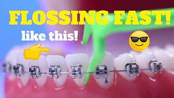 Floss Braces Fast & Easy. The Ultimate Tool for Braces - The Harp Flosser!