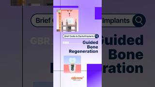 Guided Bone Regeneration