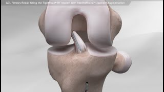 ACL Primary Repair Using the TightRope® RT Implant With InternalBrace™ Ligament Augmentation