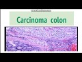 Carcinoma colon: Pathogenesis, Morphology and clinical features