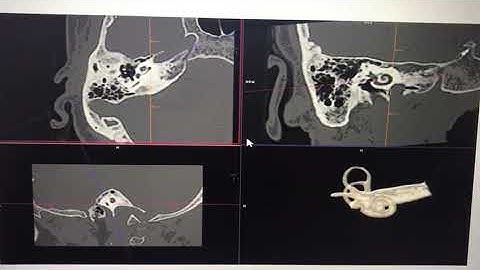 CT 3D reconstructed cochlea..