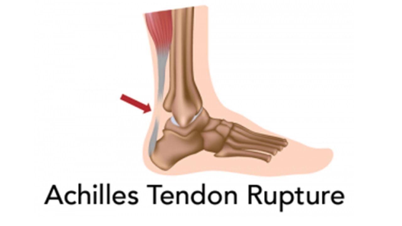 Achilles Tendon Rupture TI Health And Fitness Medical Exercise Protocol ...