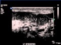 ultrasound of sperm in epididymus.wmv